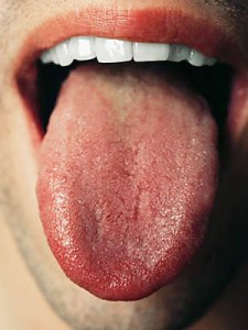 舌の火傷