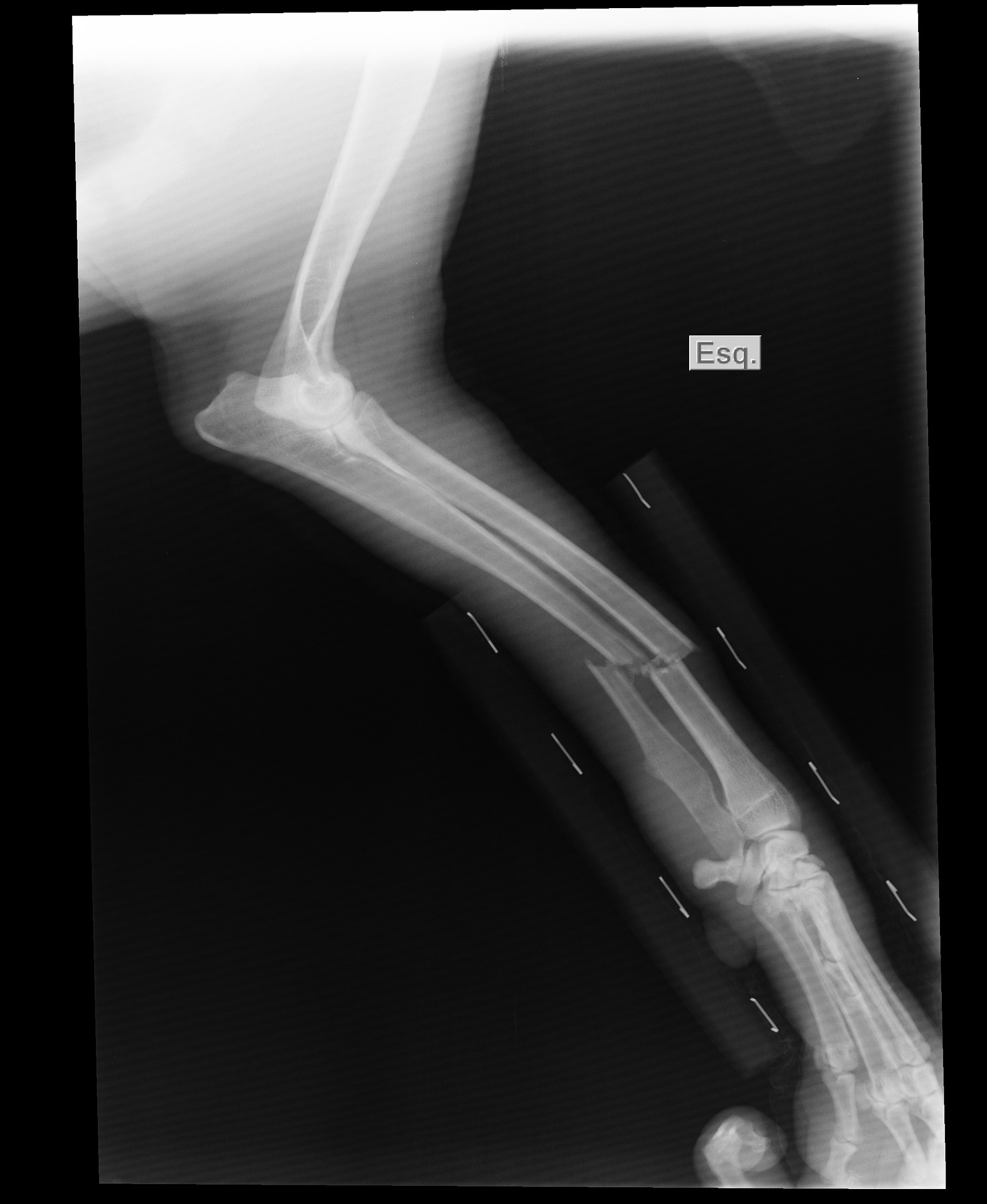 broken-arm-1188175_1920