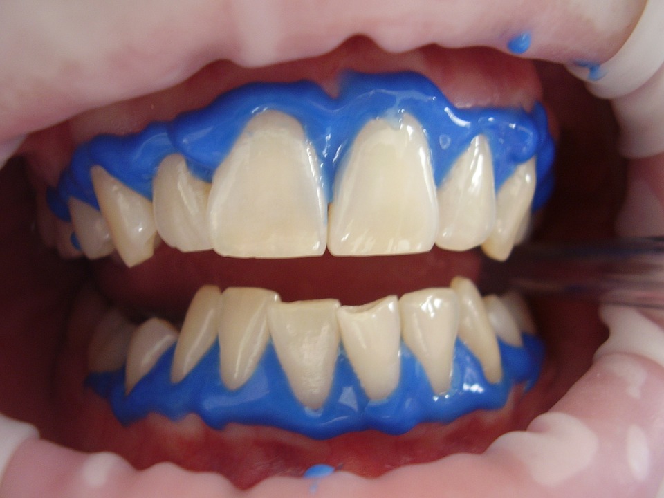 laser-teeth-whitening-716468_960_720