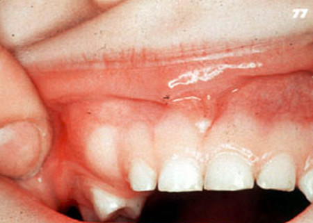 歯牙腫