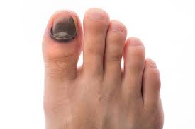 足の爪が黒い７つの原因とは 斑点が現れている人は要注意 Hapila ハピラ