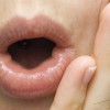 口の中に血豆が出来る５つの原因とは？病気の可能性と治し方を紹介！
