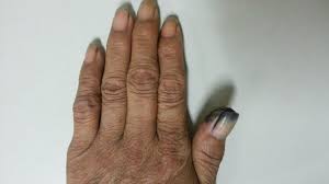 メラノーマが爪に出来てる 見分け方や他の病気の可能性について Hapila ハピラ