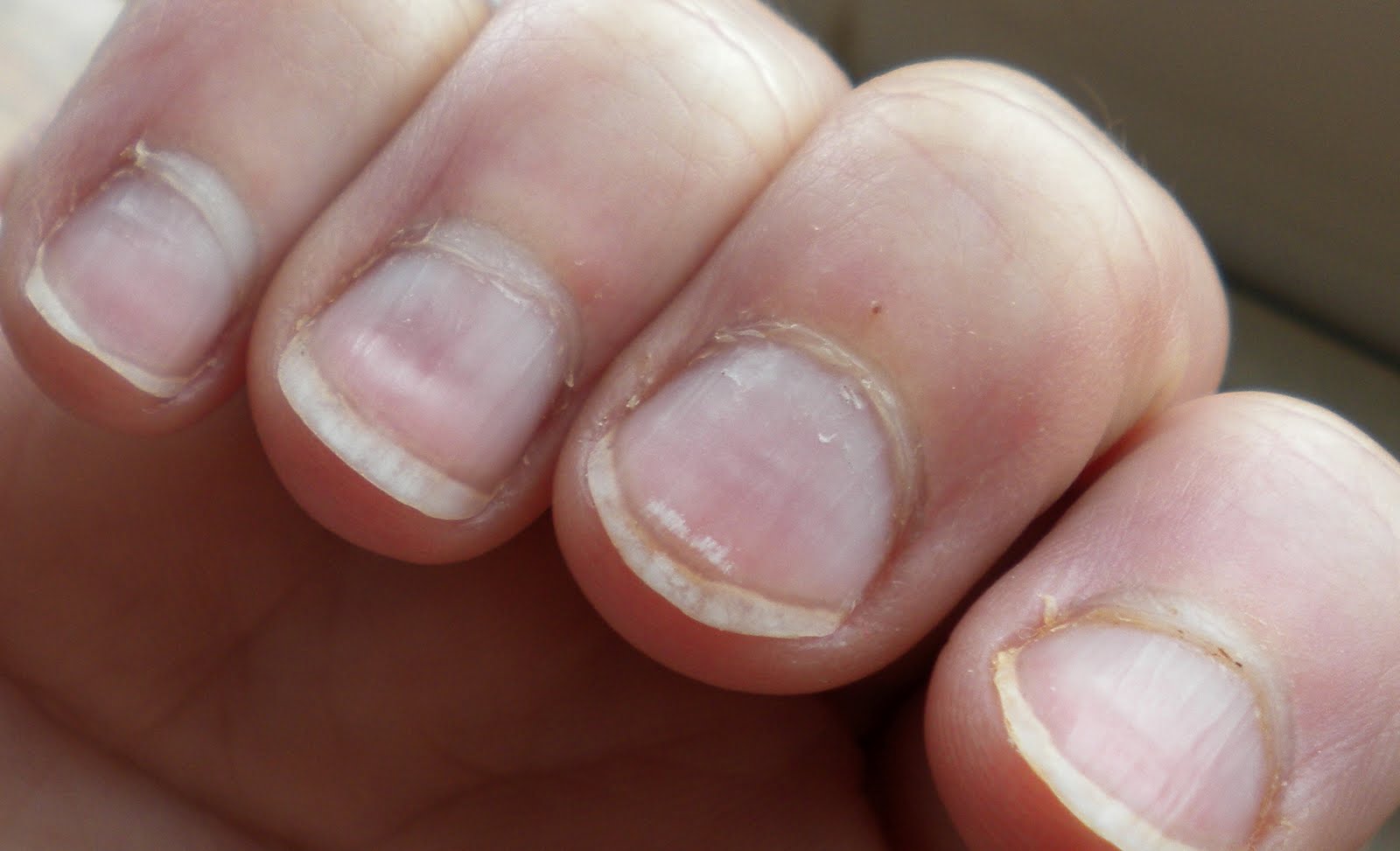 二枚爪の原因と治し方を紹介 二枚爪が発生しやすい病気とは Hapila ハピラ