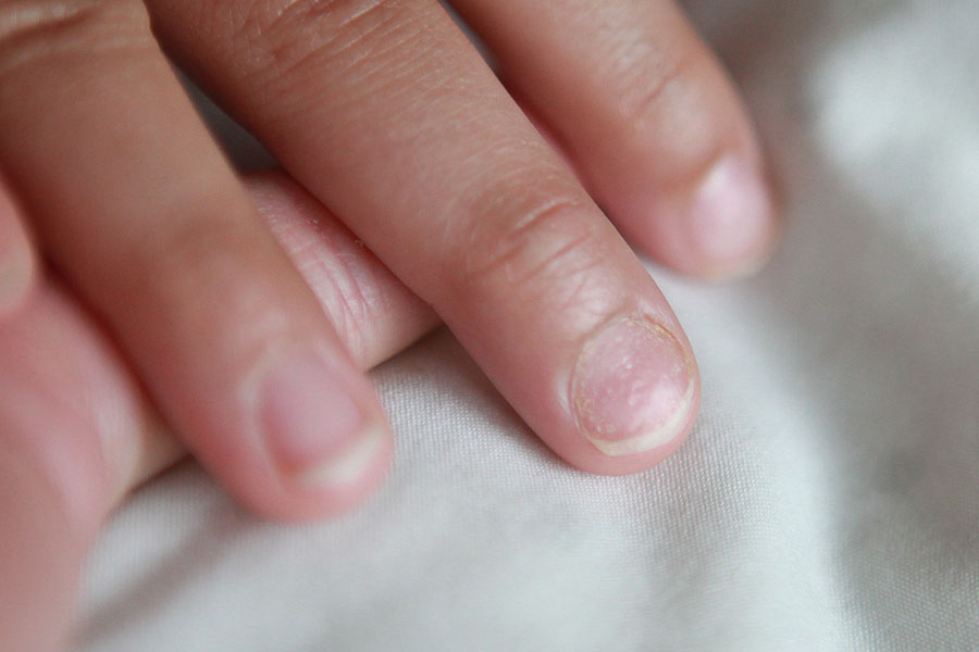 爪の変形の原因とは 病気や治療方法の紹介 Hapila ハピラ