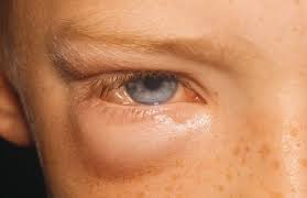 目の下の腫れの原因は 痛みやかゆみの症状はどの病気 Hapila ハピラ