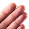 指の皮がむける原因は？病気や予防方法について