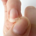 爪が割れる８つの原因は？病気の可能性や処置方法について！