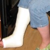 足首の骨折の症状とは？歩けるまでに手術やリハビリが必要？
