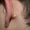 耳の後ろのしこりの原因とは？痛くないの病気もある？