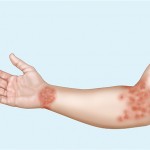 腕の湿疹の５つの原因とは？かゆみがあるのは病気？
