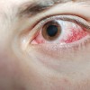 眼球が出血する病気とは？治療法や予防法について！