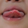 舌の先が痛い原因は？考えられる病気や治療法について