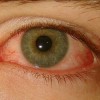 目が赤い原因！痛いと感じたり目やにが発生する病気とは？