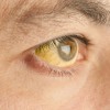 白目が黄色になる４つの原因とは？対処法や病気の可能性について！