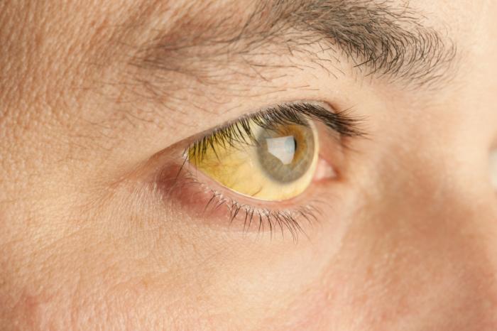 白目が黄色になる４つの原因とは 対処法や病気の可能性について Hapila ハピラ