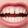 歯茎が白い原因は？痛みや腫れを感じるのは病気？
