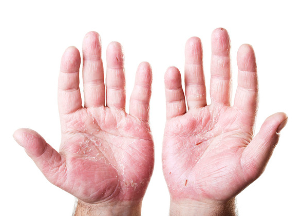 かゆみ ブツブツ 手のひら 何これ？手のひらに透明なぶつぶつ…かゆい・かゆくない。原因は？どう治す？