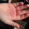 手のひらの湿疹の原因とは？痛みやかゆみのある病気って？