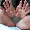 手足口病が大人に発症した時の症状とは？感染経路や治療法について！