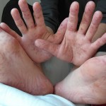 手足口病が大人に発症した時の症状とは？感染経路や治療法について！