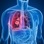 肺炎の死亡率が高いのはなぜ？種類や症状を把握しておこう！