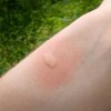 蚊に刺された時の対処について！腫れや跡を残さない方法は？