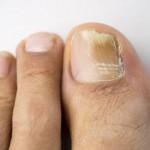 足の爪が痛い３つの原因とは？痛みを感じる部位で分かる病気って？