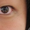片目だけ充血する６つの原因は？病気の可能性や対策方法を知っておこう！