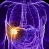 肝臓がんの末期症状について！生存率や余命はどのくらい？