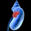 腎臓がんの生存率はどのくらい？原因や症状、治療法について！