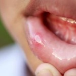 口内炎に塩を塗ると早く治るって本当？注意点や他の治療法を紹介！