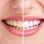 歯の黄ばみの原因は？除去する方法や対処方法を紹介！
