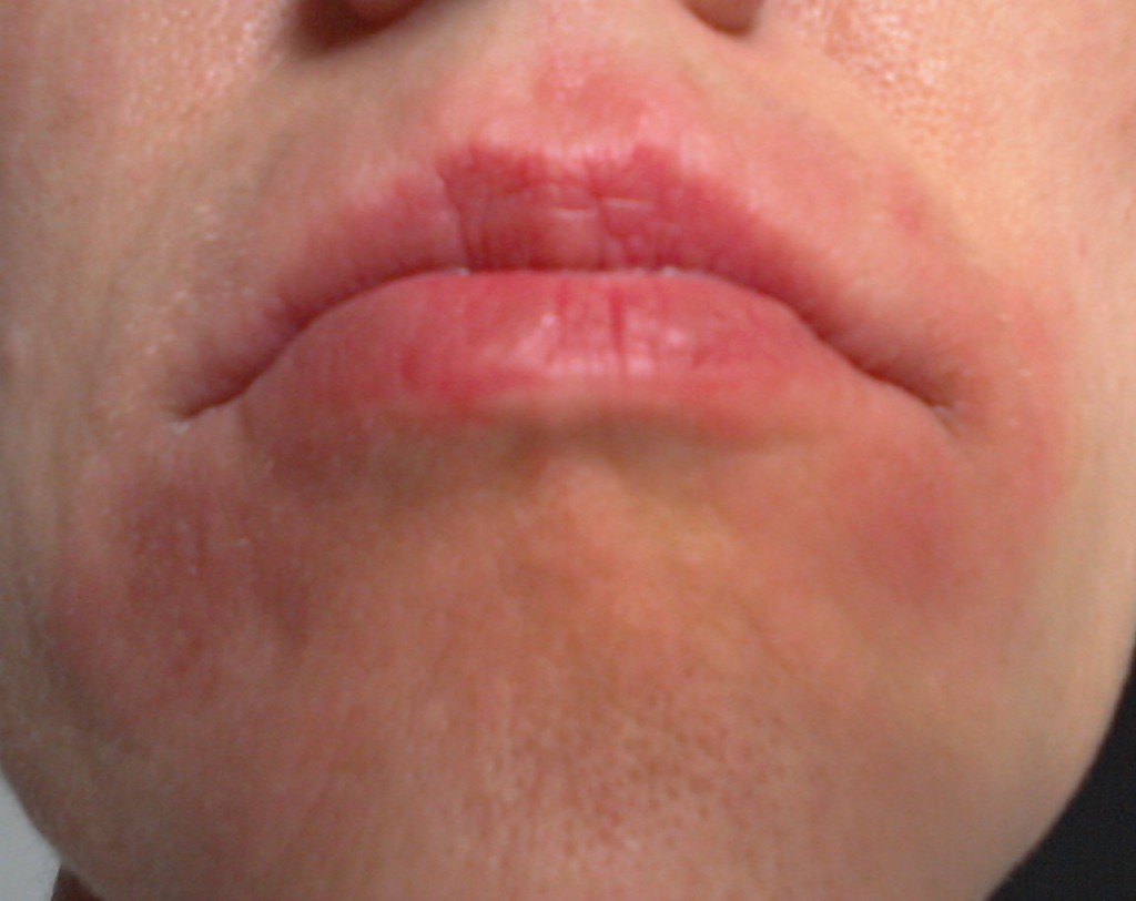 口の周りに湿疹が出来る８つの原因は ケア方法と病気の症状を紹介 Hapila ハピラ