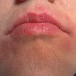 口の周りに湿疹が出来る８つの原因は？ケア方法と病気の症状を紹介！