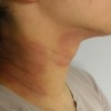 首の湿疹が出来る原因とは？症状や治療方法も紹介！