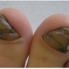 爪のカビって？グリーンネイルの症状と原因、治療方法を紹介！
