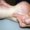 アキレス腱周囲炎とは？症状や原因、治療方法を知ろう！