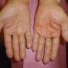 異汗性湿疹とは？症状・原因・治療方法を詳しく紹介！