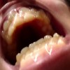 歯茎に膿が発生する原因は？してはいけない事や病気を紹介！