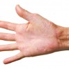 手のひらがぶつぶつになる病気って？症状や対策方法を紹介！