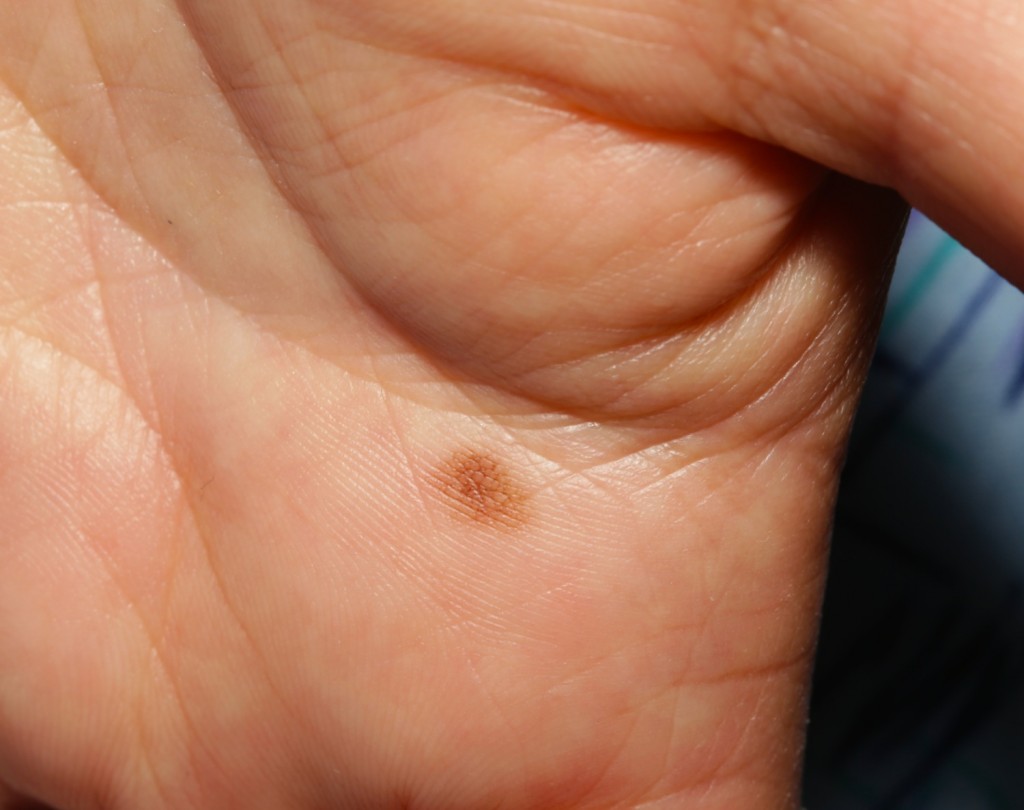 異形成母斑は黒色腫に変化しますか?