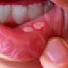 口内炎を潰すのは逆効果！正しい治し方と予防方法を知ろう！