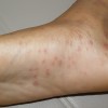 ジベルバラ色粃糠疹とは？症状や原因、治療法を詳しく！