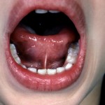 舌癒着症の症状とは？大人と赤ちゃんとの違いや、手術についての見解を紹介！