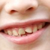 歯が欠けた時の応急処置！治療法と放置の危険性を紹介！