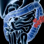大腸がんの手術の方法は？手術後の注意点や食事について！