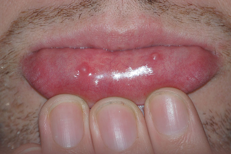 粘液嚢胞とは？症状や原因、治療する方法を理解しよう！ Hapila [ハピラ]