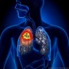 肺腺癌とは？症状や原因、肺がんとの違いなどを紹介！