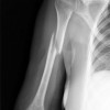 上腕骨近位端骨折とは？症状や治療方法を知っておこう！